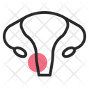 پیش‌نمایش فایل uterus-1860189 از پک سرطان