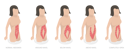پیش‌نمایش فایل abdominal-muscle-diastase-and-women-problem-after-pregnancy-9913931 از پک مجموعه موضوعات متنوع ۰۷۳