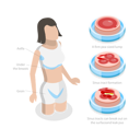 پیش‌نمایش فایل hidradenitis-suppurativa-10730722 از پک مجموعه موضوعات متنوع ۱۱۲