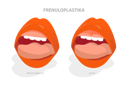 پیش‌نمایش فایل lip-tie-before-and-after-surgery-10730538 از پک مجموعه موضوعات متنوع ۱۰۷