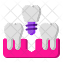 پیش‌نمایش فایل tooth-implant-1664756 از پک دندانپزشکی